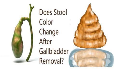 clay colored stool no gallbladder.